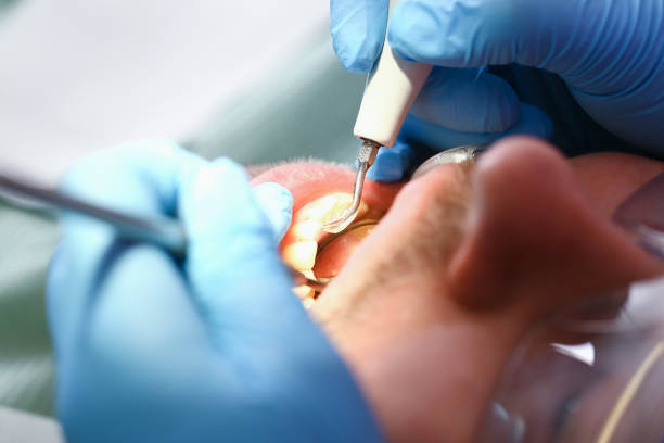 Best Emergency Wisdom Teeth Removal in Mccullom Lake, IL